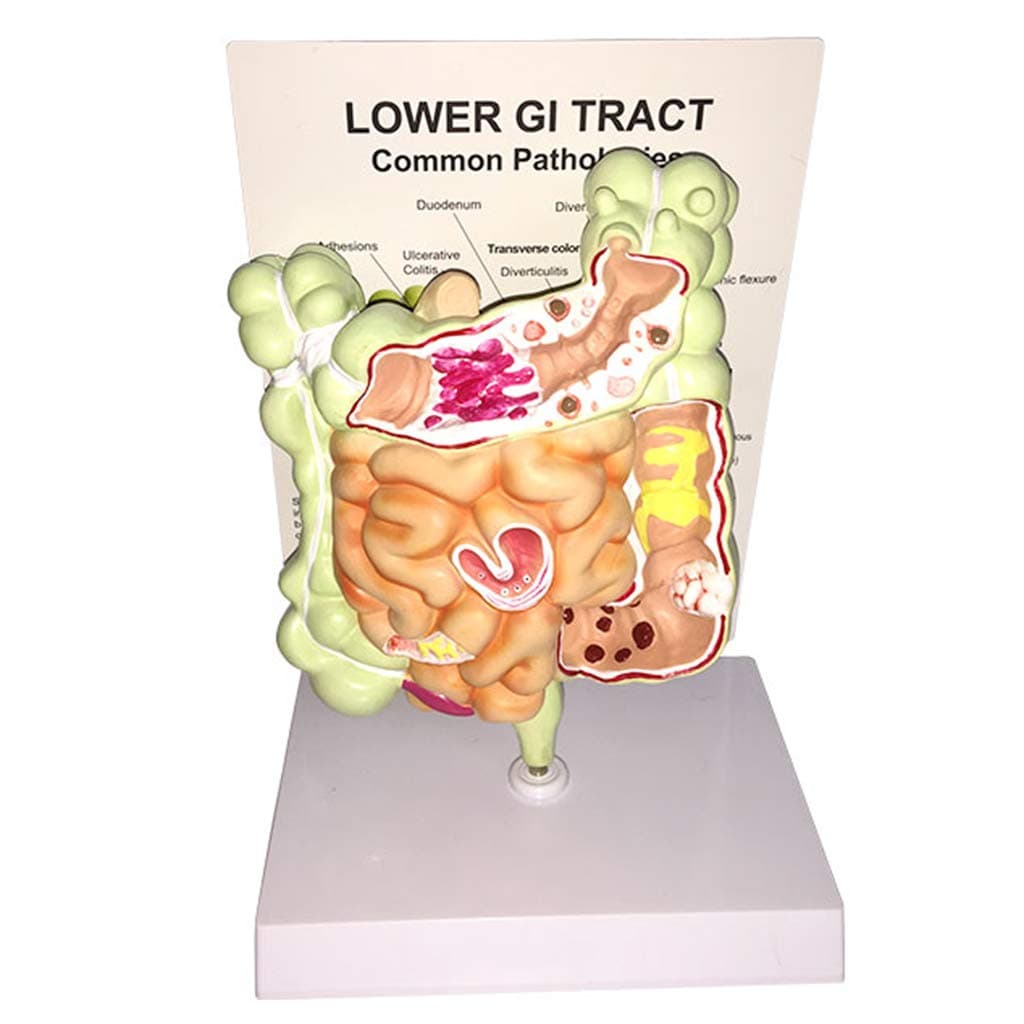 Human Digestive System Model - Human Large Intestine Pathology Model Gut Anatomy Intestinal Lesion Cecal Rectum Duodenal Ulcer Anatomical Model - for Medical